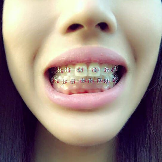 What do Braces Bands Do and What secrets do they reveal?